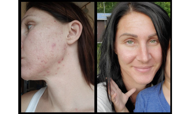 Acné - Traitement 100% naturel & actif
