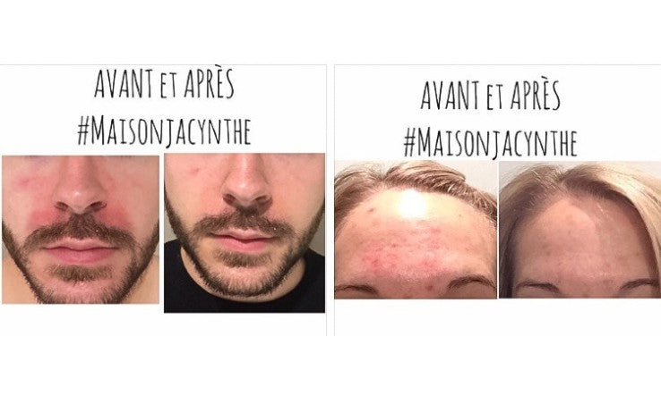 Crise d'eczéma et problème de boutons résolus naturellement